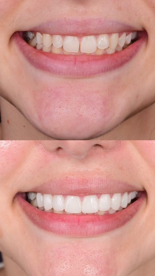 Before and after Porcelain Veneers — patient of Dr. Ali Esfahani, Century City dentist