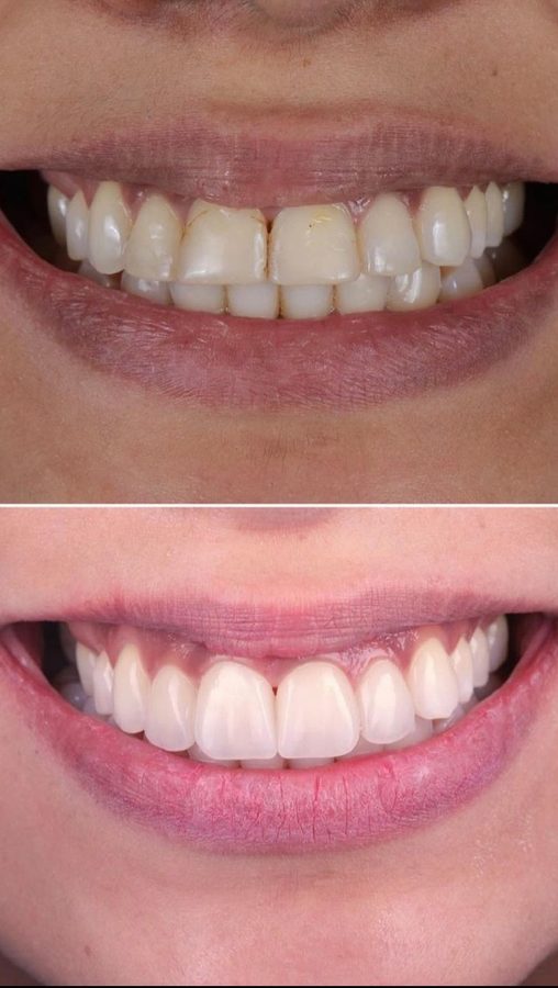 Before and after Porcelain Veneers — patient of Dr. Ali Esfahani, Century City dentist