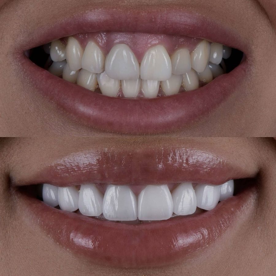 Before and after Smile Makeover — patient of Dr. Ali Esfahani, Century City dentist