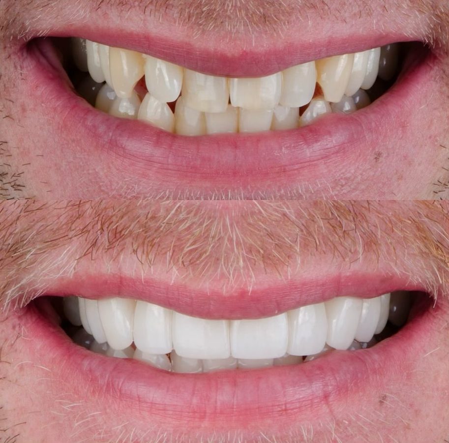 Before and after Veneers & Whitening — patient of Dr. Ali Esfahani, Century City dentist