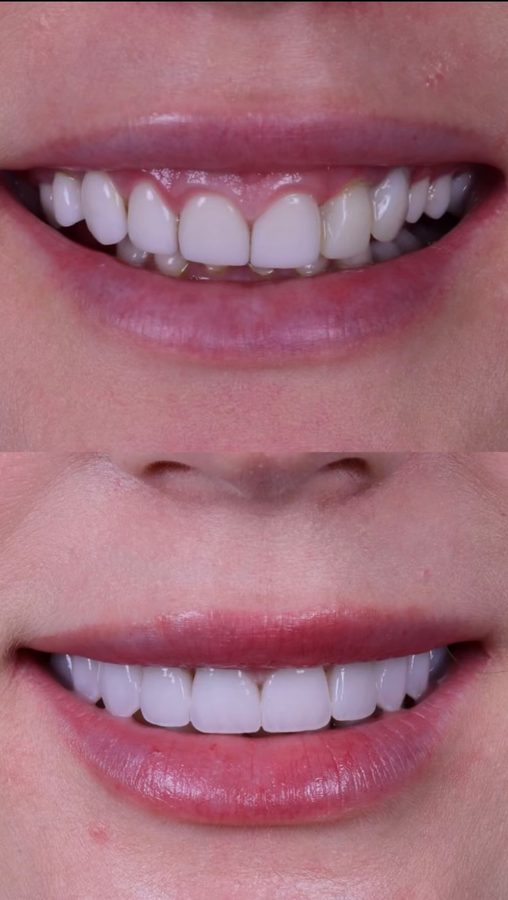 Before and after Porcelain Veneers — patient of Dr. Ali Esfahani, Century City dentist