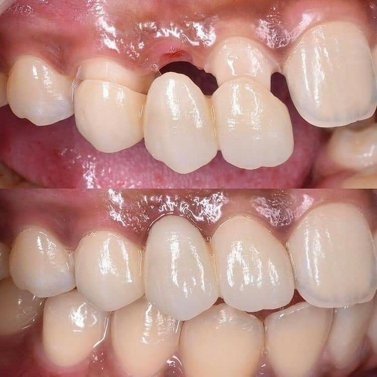 Before and after Implant & Crown — patient of Dr. Ali Esfahani, Century City dentist