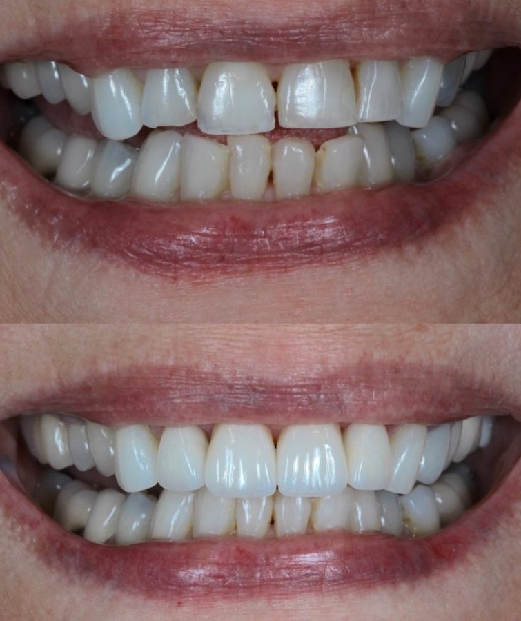 Before and after Full-Mouth Restoration — patient of Dr. Ali Esfahani, Century City dentist