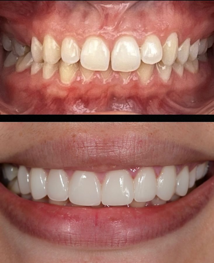 Before and after Smile Makeover — patient of Dr. Ali Esfahani, Century City dentist