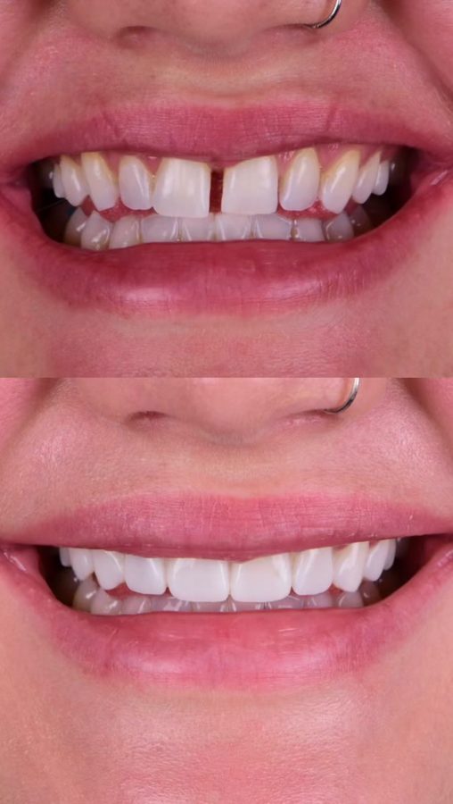 Before and after Gap Closure — patient of Dr. Ali Esfahani, Century City dentist