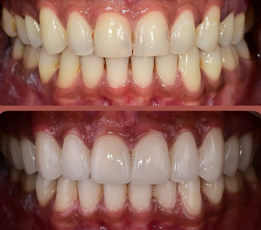 Before and after Porcelain Crowns — patient of Dr. Ali Esfahani, Century City dentist