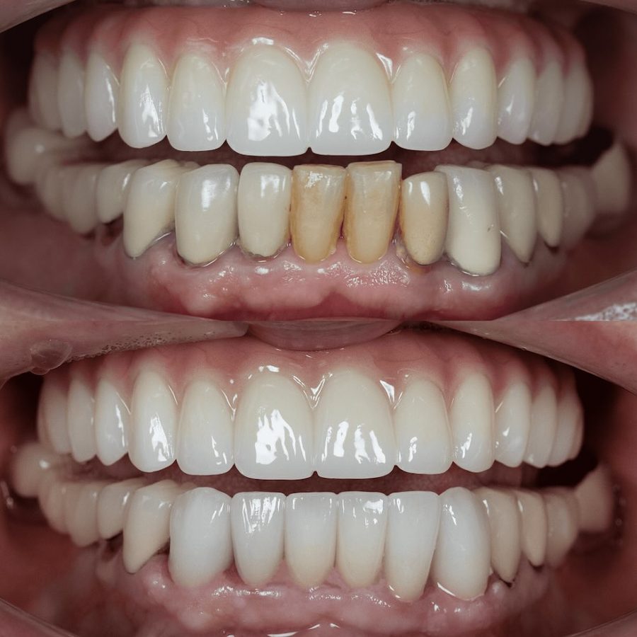 Before and after Crowns & Whitening — patient of Dr. Ali Esfahani, Century City dentist