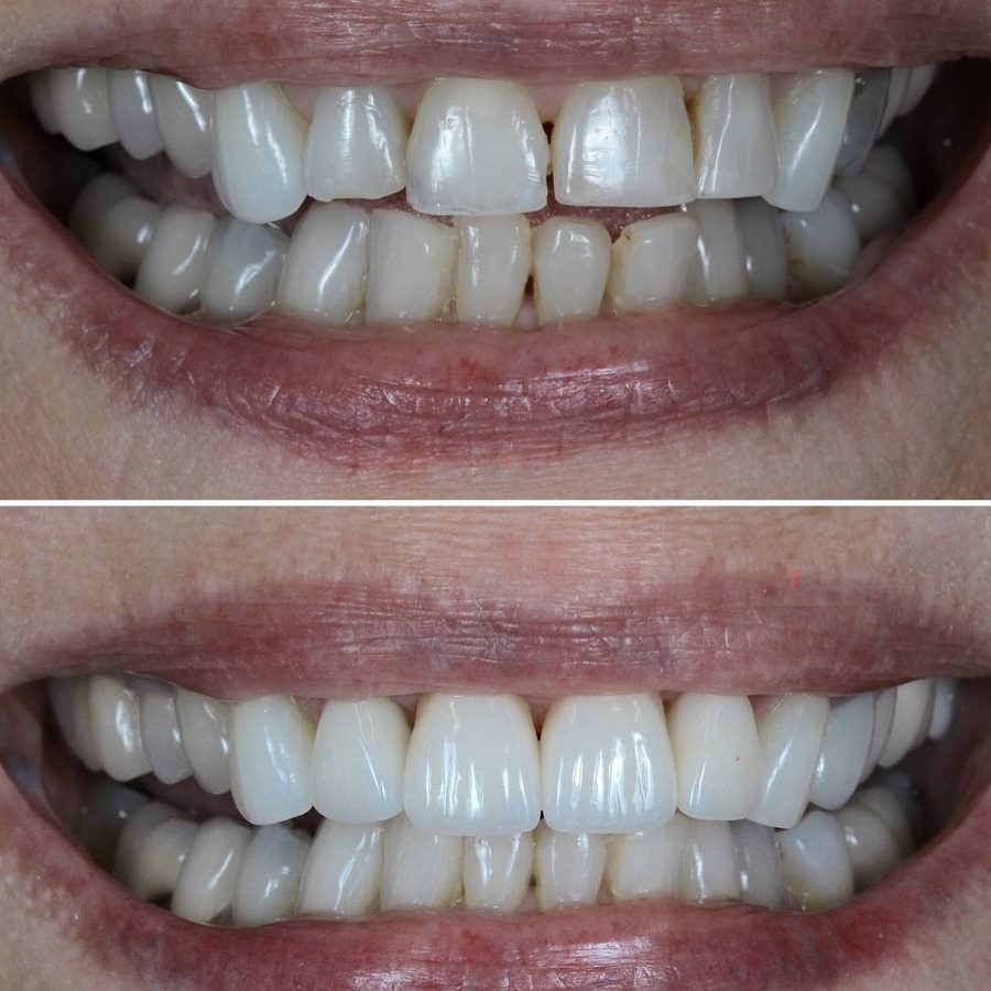 Before and after Smile Restoration — patient of Dr. Ali Esfahani, Century City dentist