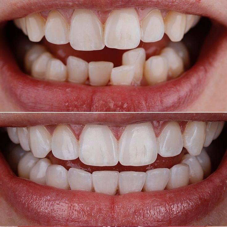 Before and after Teeth Alignment — patient of Dr. Ali Esfahani, Century City dentist