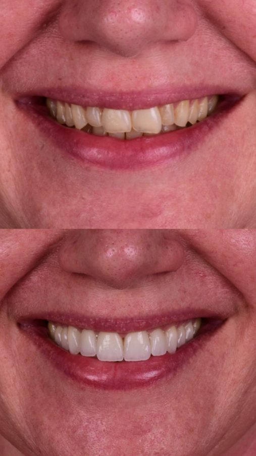 Before and after Porcelain Veneers — patient of Dr. Ali Esfahani, Century City dentist