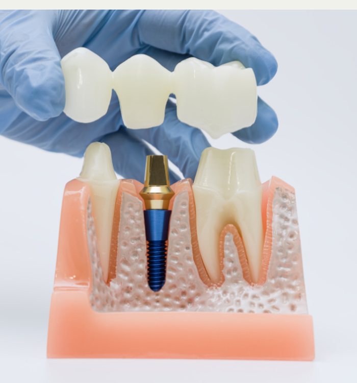 Dental implant treatment at Century Smile Maker