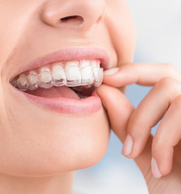 Invisalign clear aligners and 3D digital scanning