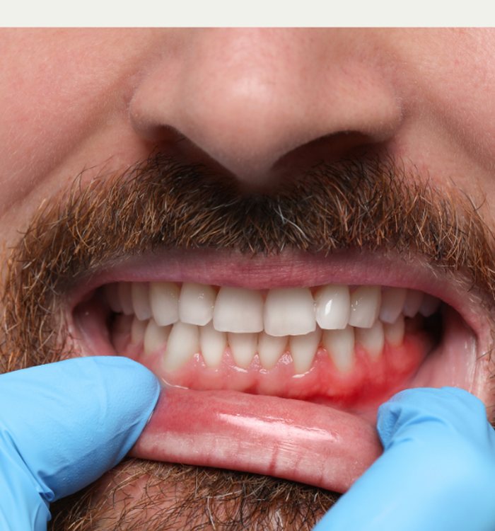 Periodontics & Gum Disease Treatment — Century City dental care