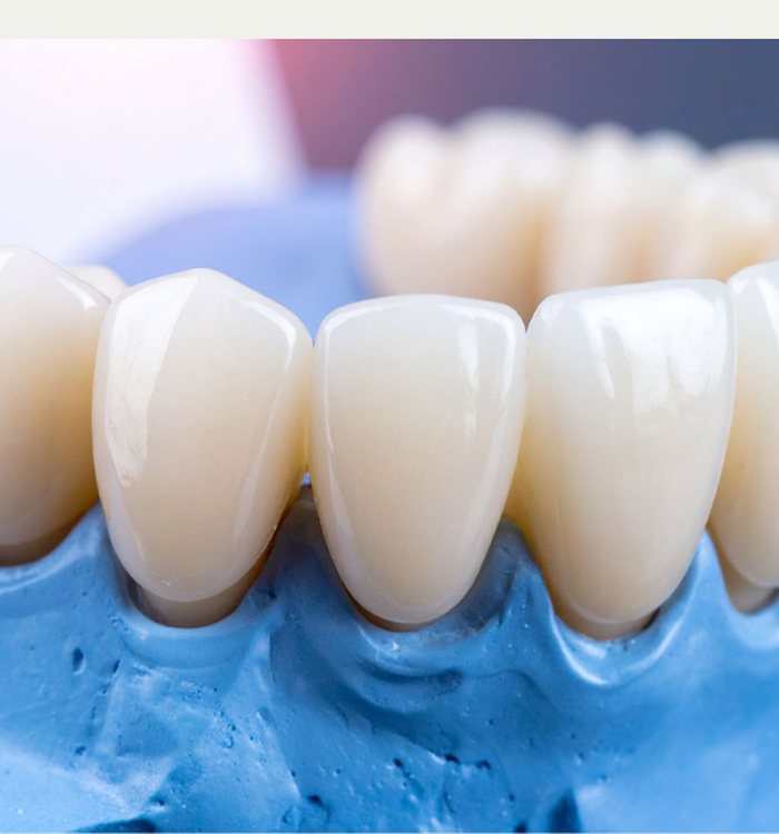 Porcelain veneers