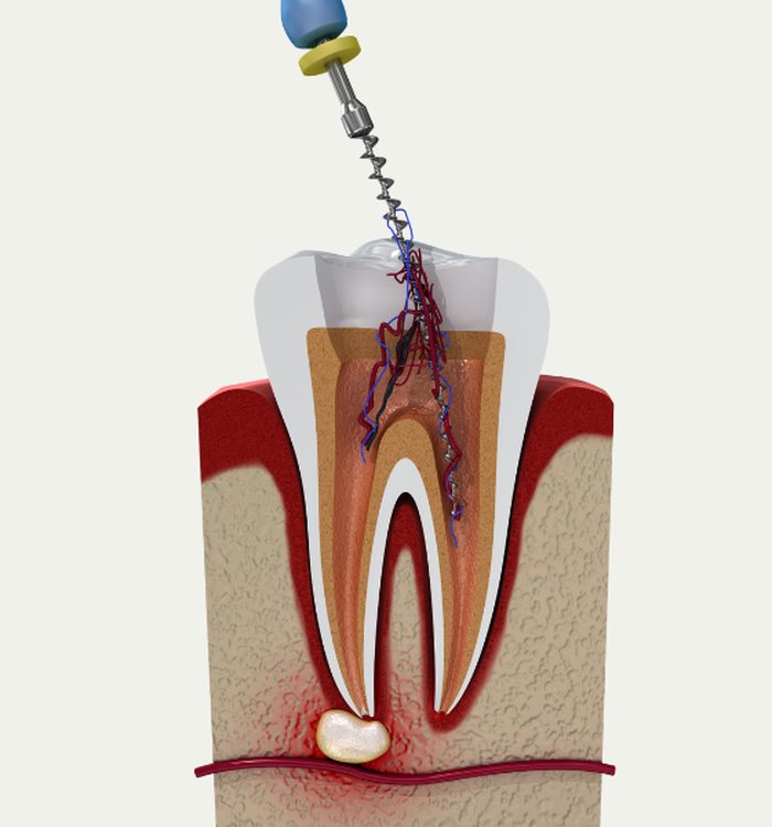 Root Canal Therapy — Century City dental care
