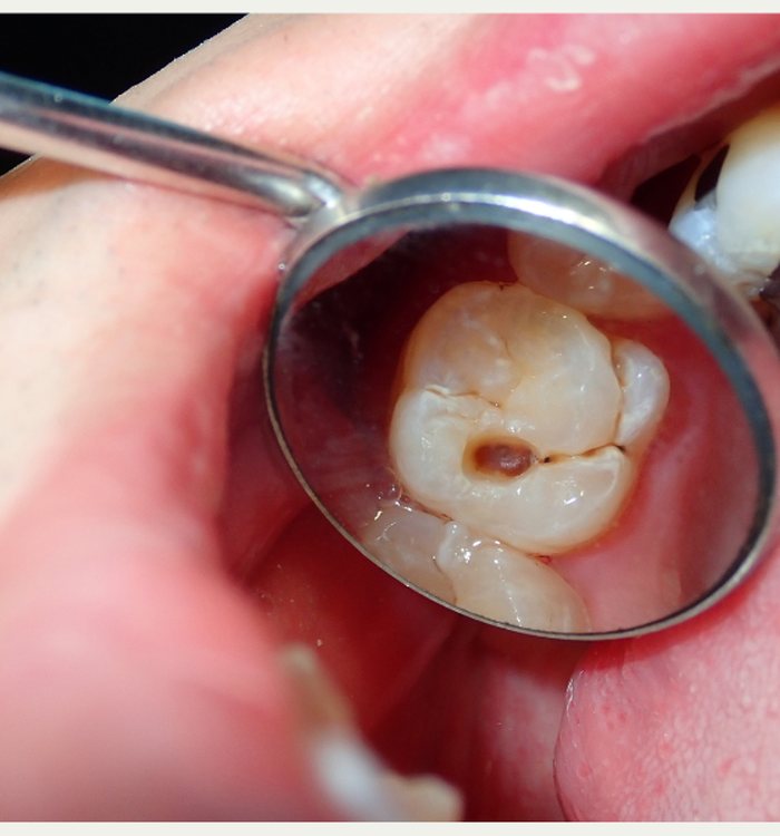 Tooth-Colored Fillings — Century City dental care