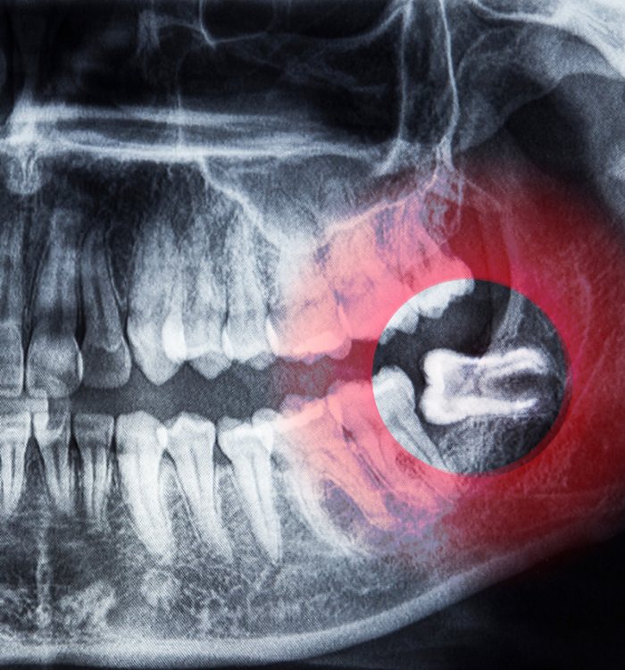 Tooth Extraction — Century City dental care